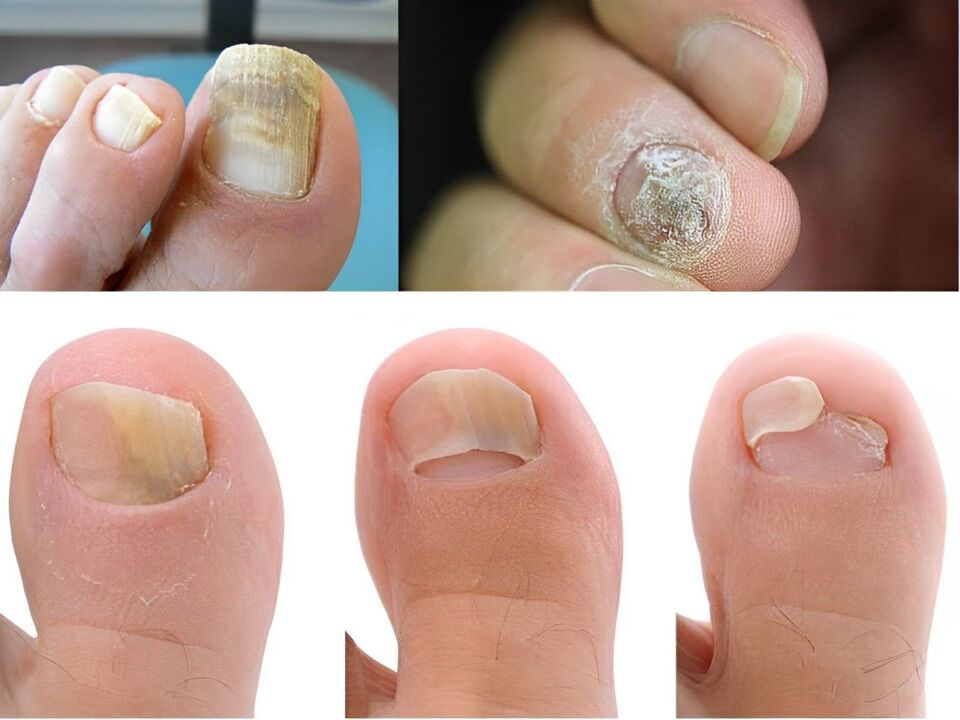 Etapp vun Onychomycosis